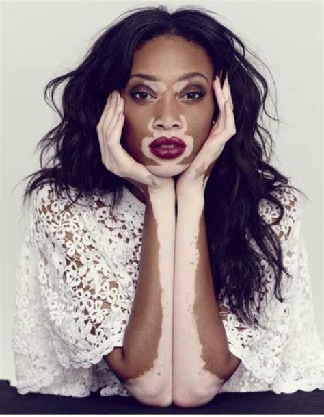 winnie harlow vitiligo